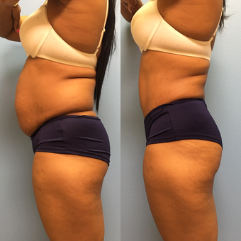 31 year-old woman treated with Tummy Tuck and Lipo 360 after 3487708