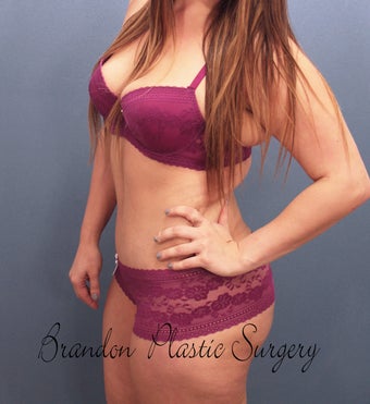 Tummy Tuck 2526061