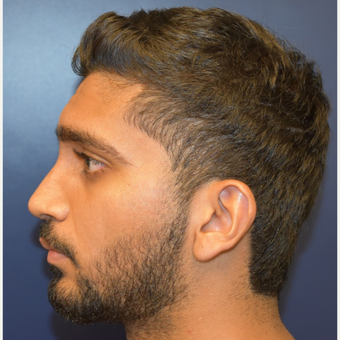 18-24 year old man treated with Rhinoplasty after 3226878