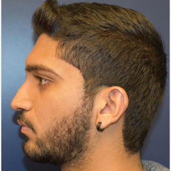 18-24 year old man treated with Rhinoplasty before 3226878