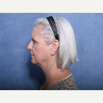 55-64 year old woman treated with Neck Lift (view 2 of 2) before 3179820