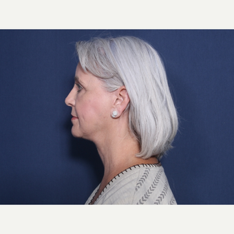 55-64 year old woman treated with Neck Lift (view 2 of 2) after 3179820