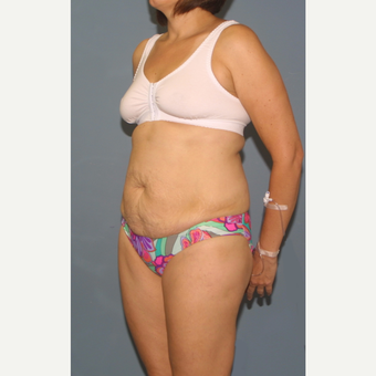 25-34 year old woman treated with Tummy Tuck before 3564271