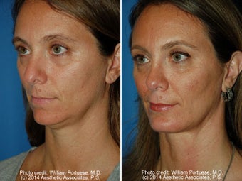 Neck Liposuction before 1389721
