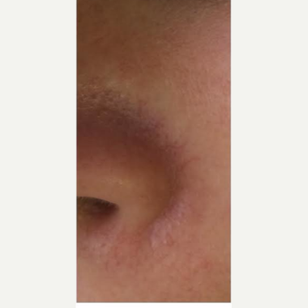 35-44 year old woman treated with IPL before 2995203