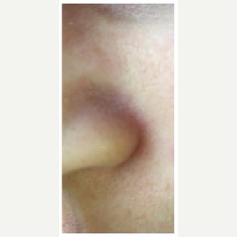 35-44 year old woman treated with IPL after 2995203