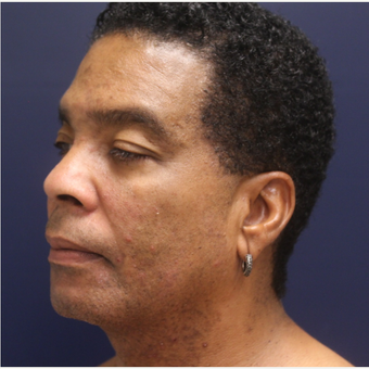 45-54 year old man treated with Smart Lipo after 3143289