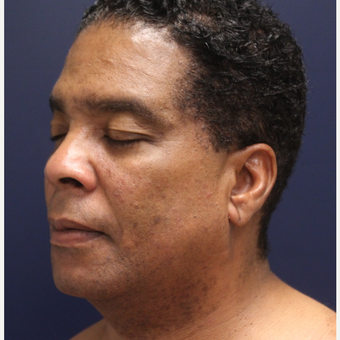 45-54 year old man treated with Smart Lipo before 3143289