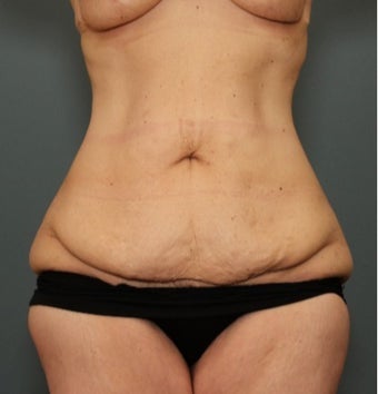 45-54 year old woman requesting Tummy Tuck after weight loss before 3070063