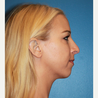 18-24 year old woman treated with Rhinoplasty before 3123327