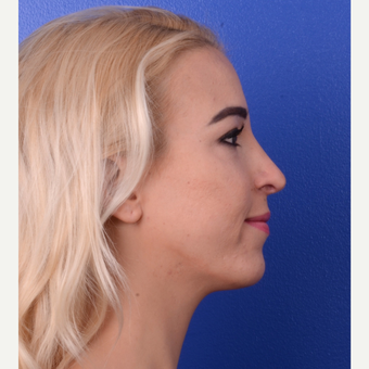 18-24 year old woman treated with Rhinoplasty after 3123327