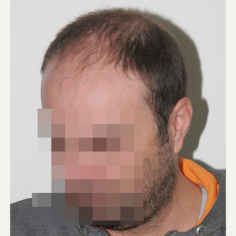 33 years old man treated with FUE Hair Transplant before 3068909
