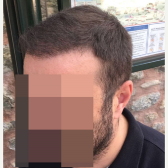 33 years old man treated with FUE Hair Transplant after 3068909