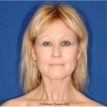 Natural Fat Transfer to the face and cheeks after 3104774