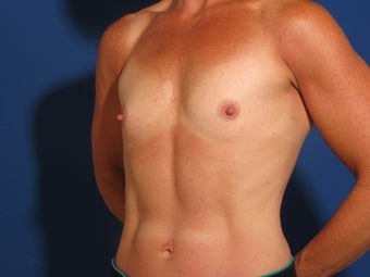 40 year old woman, body builder, treated with breast augmentation before 715474