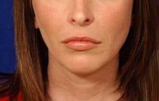 Before and After Lip Augmentation after 66153