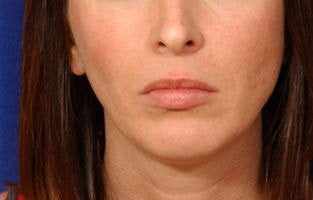 Before and After Lip Augmentation before 66153