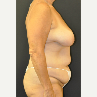 55-64 year old woman treated with Mommy Makeover before 3664292