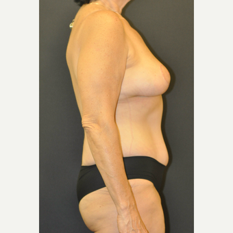 55-64 year old woman treated with Mommy Makeover after 3664292