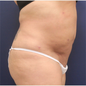 45-54 year old woman treated with Smart Lipo after 3235169