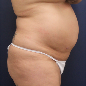 45-54 year old woman treated with Smart Lipo before 3235169