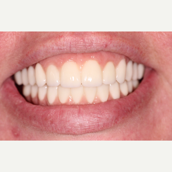 All on 4 Dental Implants after 3300720