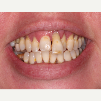 All on 4 Dental Implants before 3300720