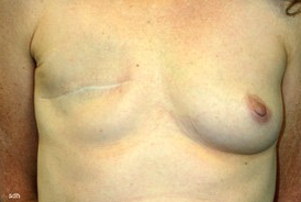 45-54 year old woman treated with Breast Reconstruction before 1675783