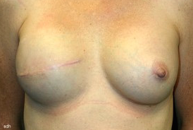 45-54 year old woman treated with Breast Reconstruction after 1675783