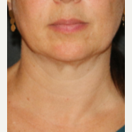 35-44 year old woman treated with CoolSculpting after 3684138