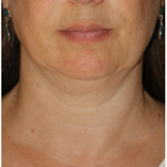 35-44 year old woman treated with CoolSculpting before 3684138