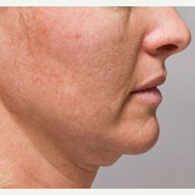 35-44 year old woman treated with Kybella before 3412333