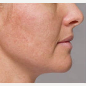 35-44 year old woman treated with Kybella after 3412333