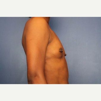34 year old female, 400cc silicone gel high profile breast implants placed under the muscle before 3813681