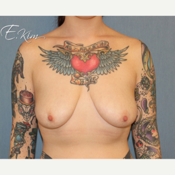 25-34 year old woman treated with Breast Lift before 3663433