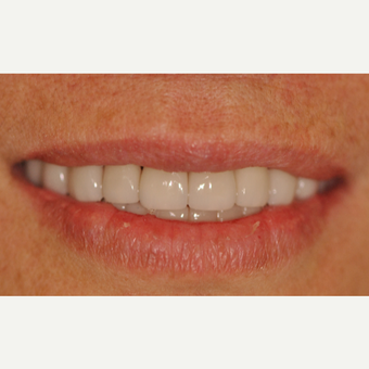 55-64 year old woman treated with Smile Makeover after 3577158