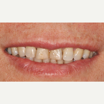 55-64 year old woman treated with Smile Makeover before 3577158