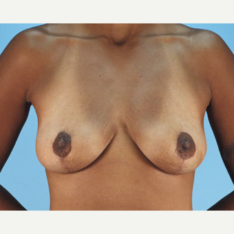 25-34 year old woman treated with Breast Lift after 3837748