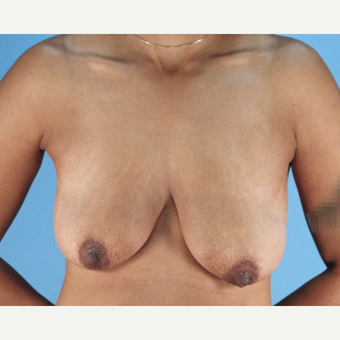 25-34 year old woman treated with Breast Lift before 3837748