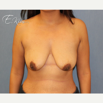 25-34 year old woman treated with Breast Augmentation before 3663351