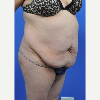 35-44 year old woman treated with Tummy Tuck before 3455275