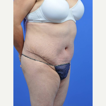 35-44 year old woman treated with Tummy Tuck after 3455275