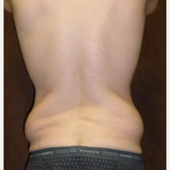 33 year old man treated with Liposuction before 1813595