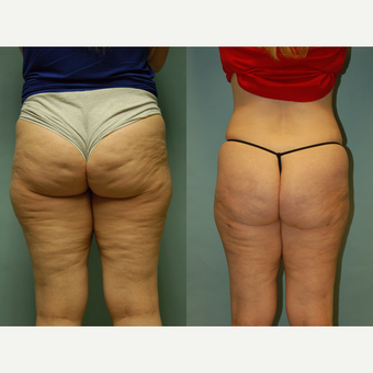 49 year-ld woman seven months post treatment with Cellulaze and Smartlipo, buttocks, hips and thighs before 3261884