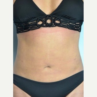 Liposuction Revision after 2132873