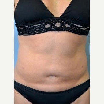 Liposuction Revision before 2132873