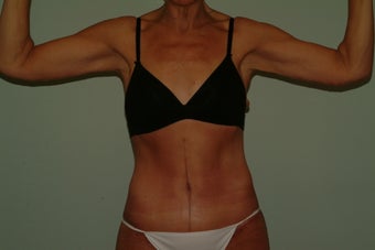 brachioplasty after 1060307