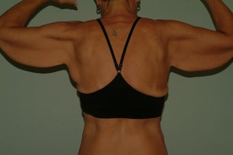 brachioplasty 1060307