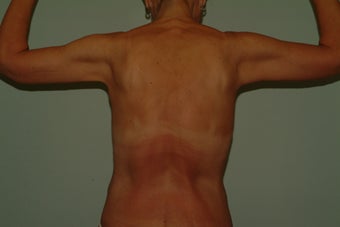 brachioplasty 1060307