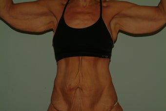 brachioplasty before 1060307